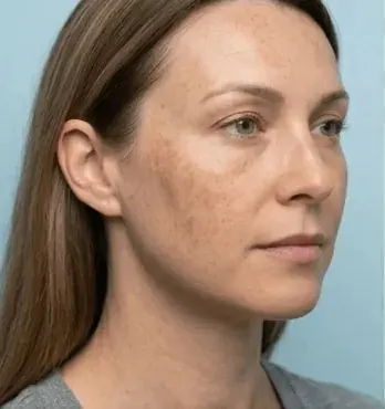 Before — Procell microchanneling — deep scar improvement